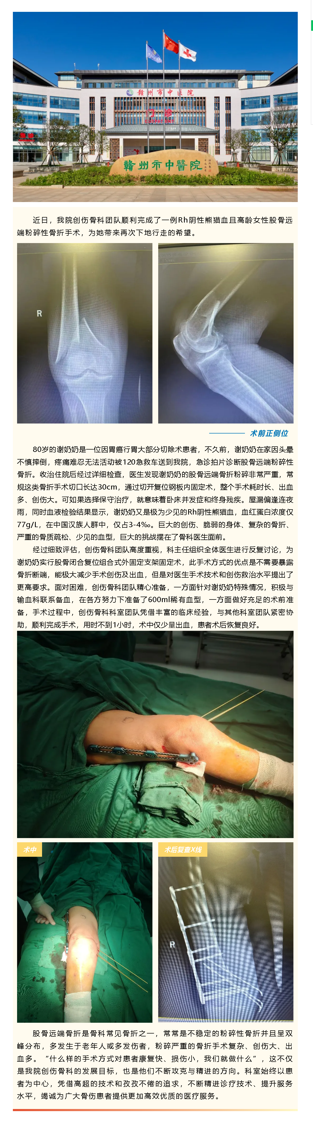 80歲粉碎性骨折阿婆竟是熊貓血，微創(chuàng)閉合復(fù)位破解創(chuàng)傷難題.png